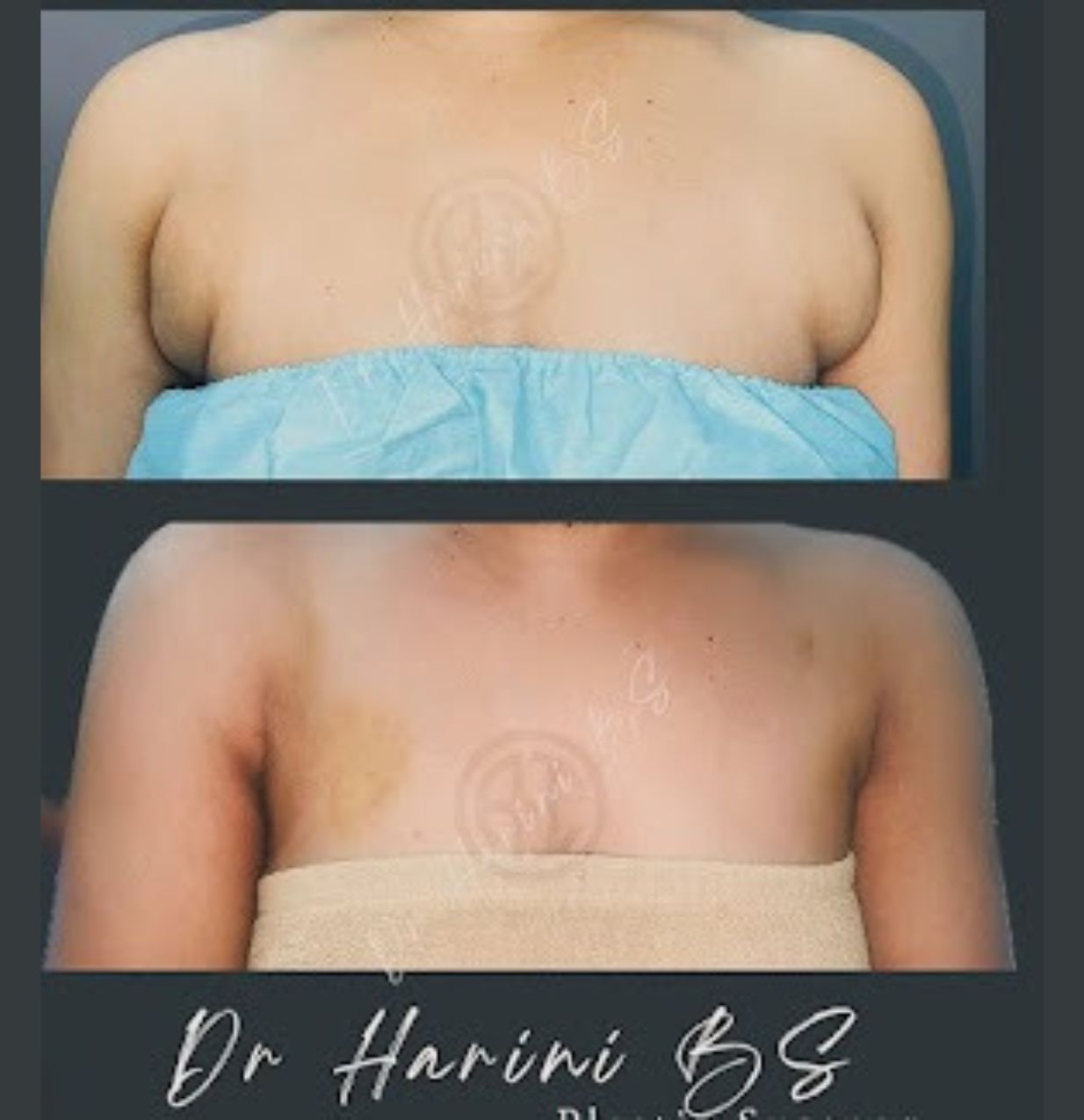 Patient body contouring transformation result