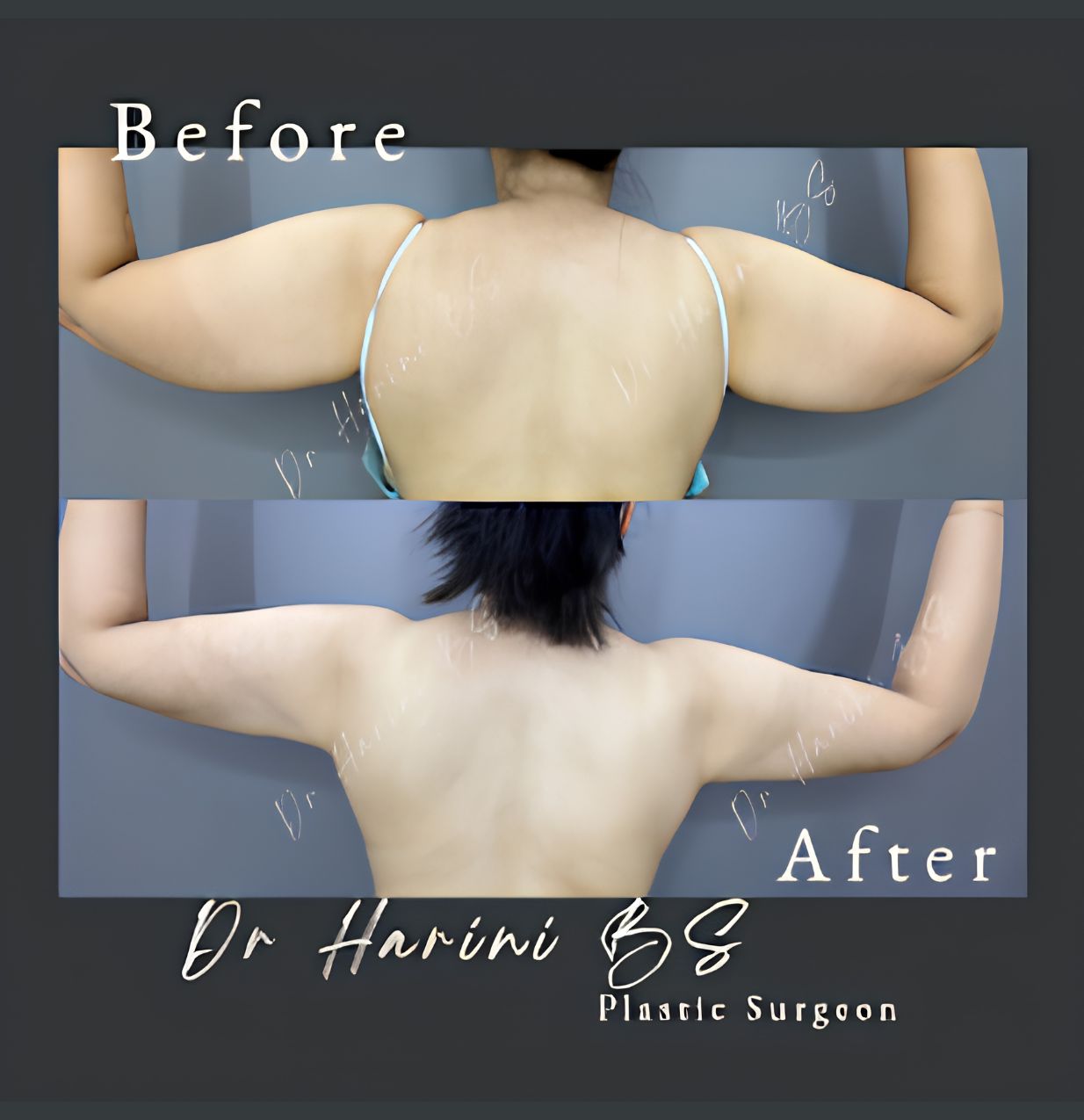 Patient body contouring transformation result