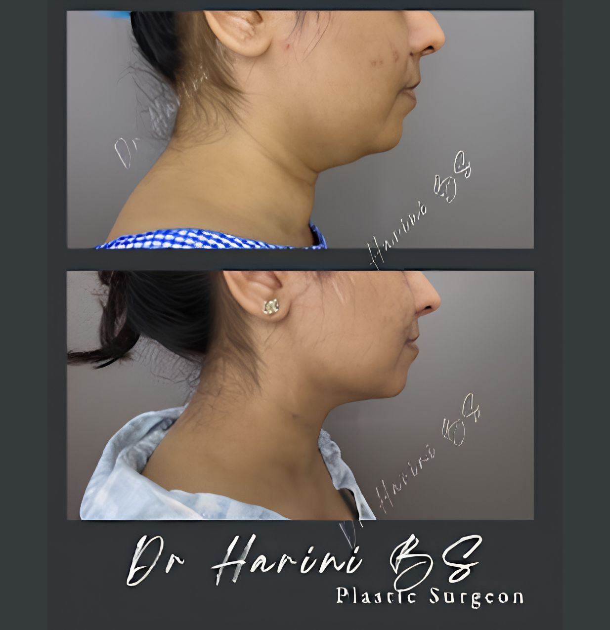 Patient body contouring transformation result