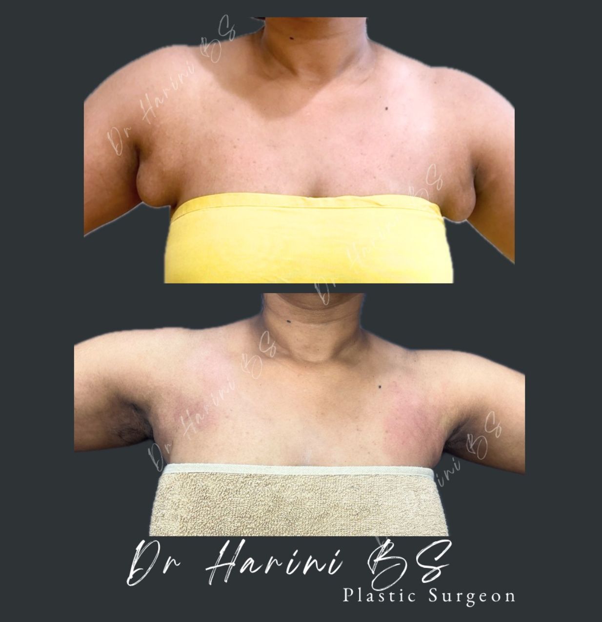 Patient body contouring transformation result