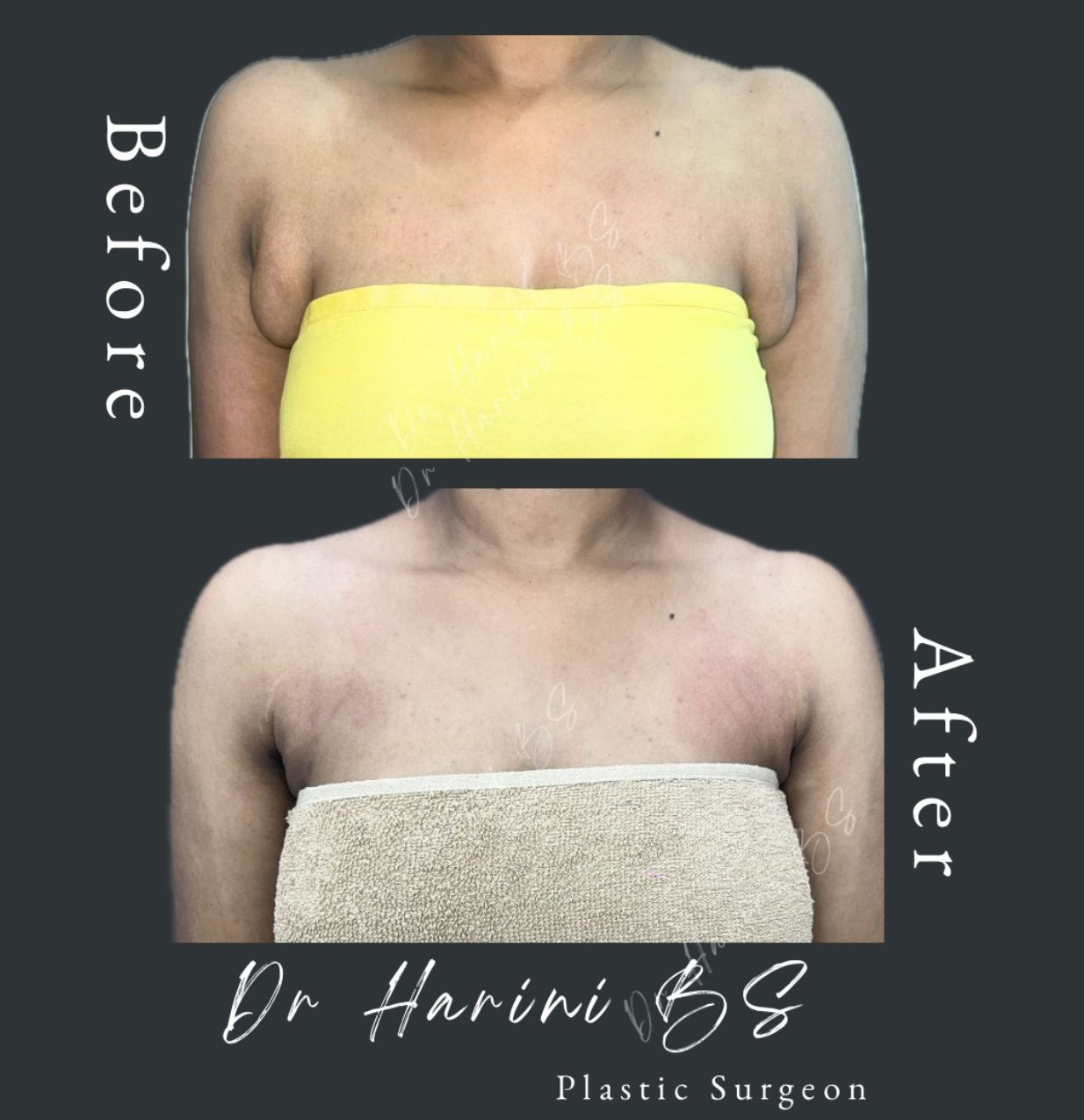 Patient body contouring transformation result