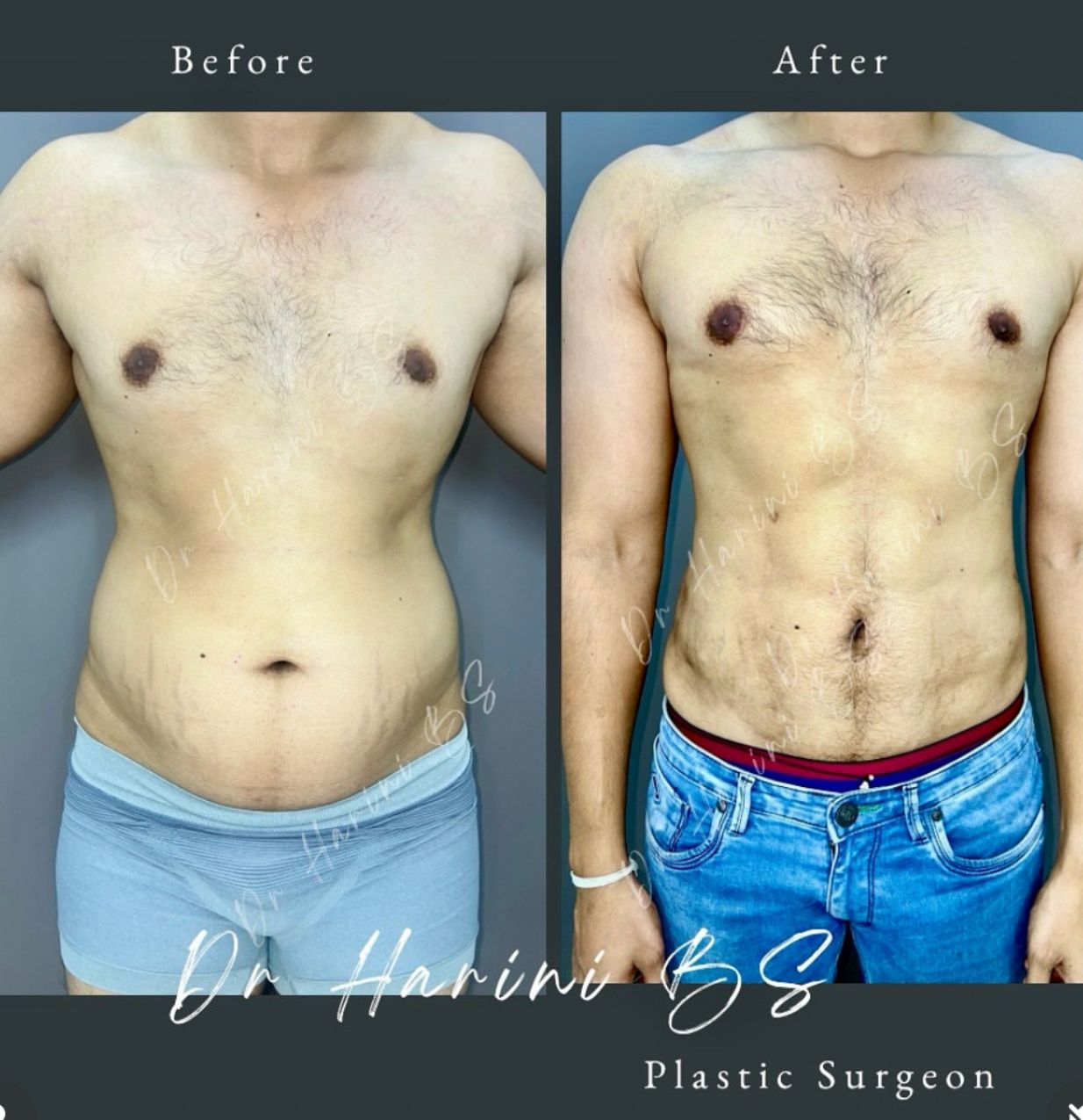 Patient body contouring transformation result