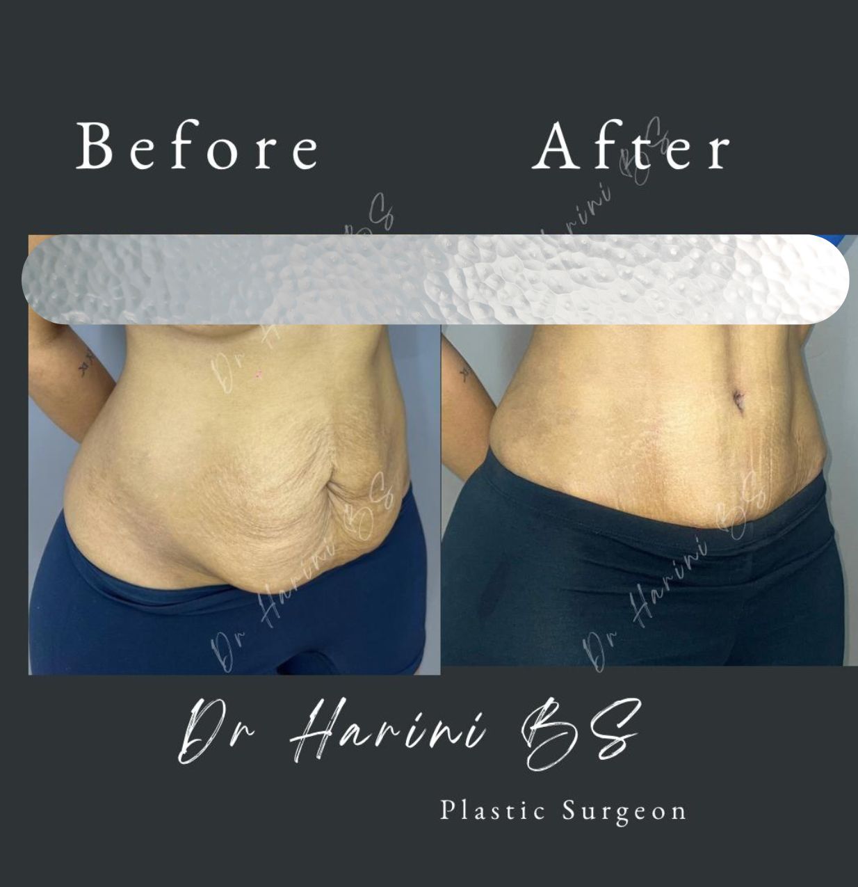 Patient body contouring transformation result