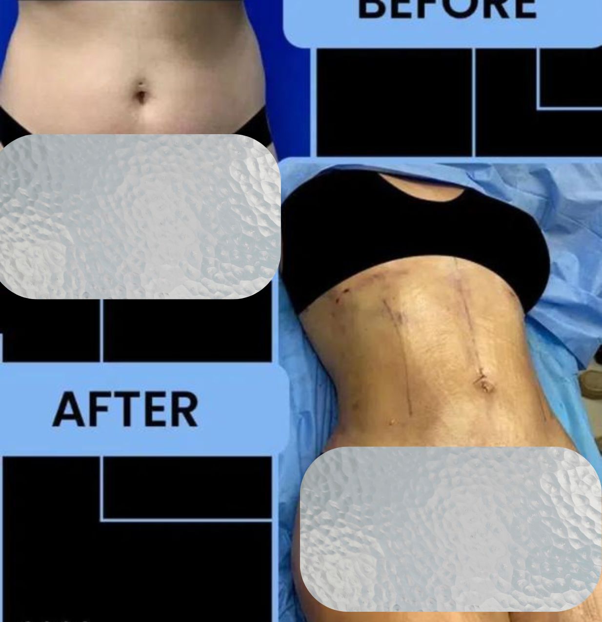 Patient body contouring transformation result