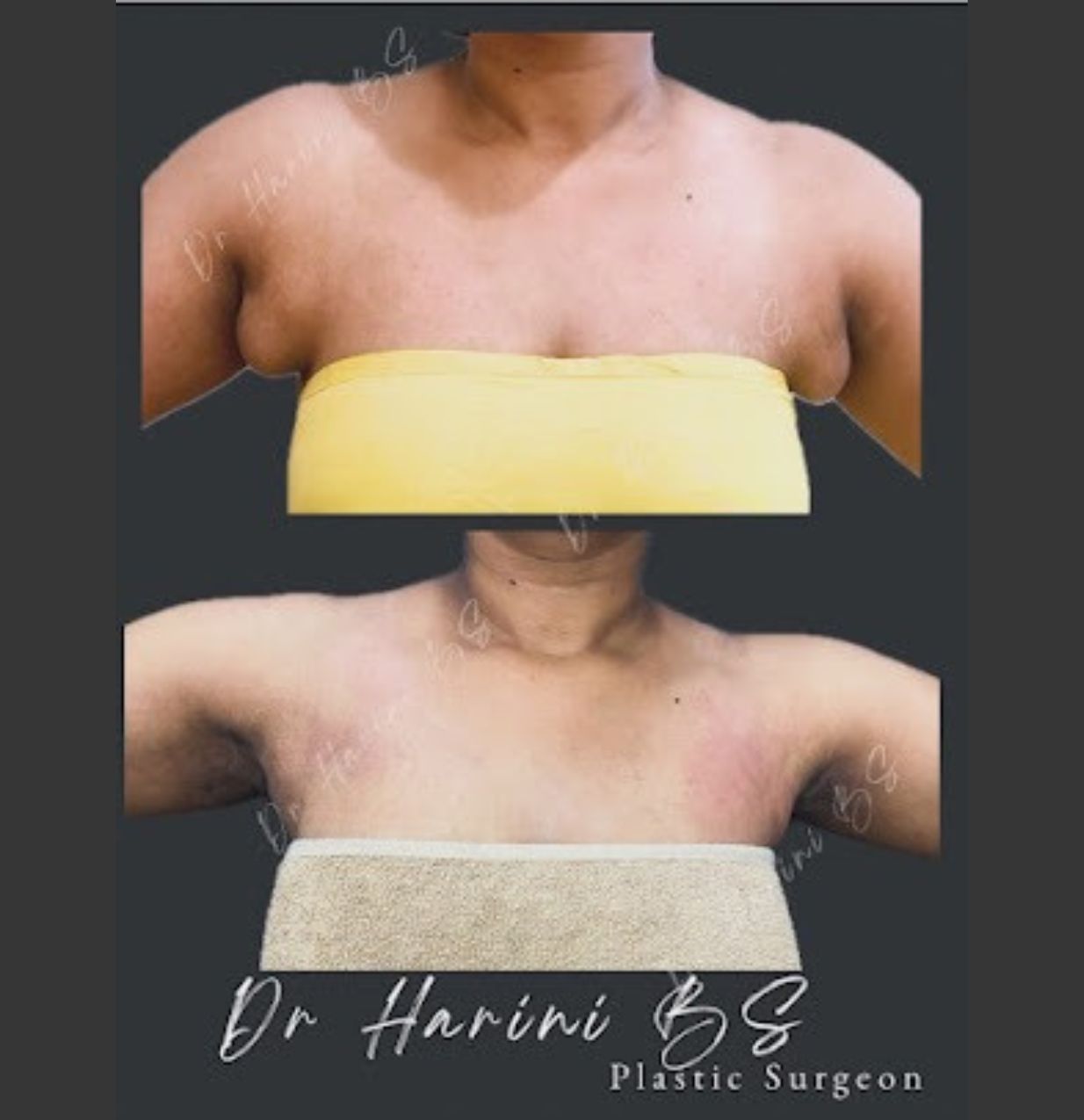 Patient body contouring transformation result
